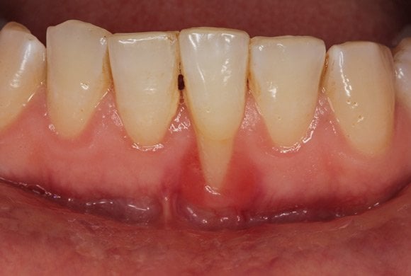 periodontitis tedavi frezleri